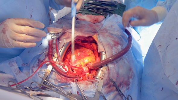 Heart Beating During Real Surgery. Open Cardiac Surgery