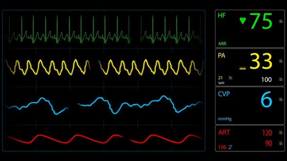 EKG Monitor Screen