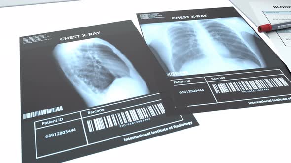 2 Lung X-ray Images and Blood Test For Virus 4k