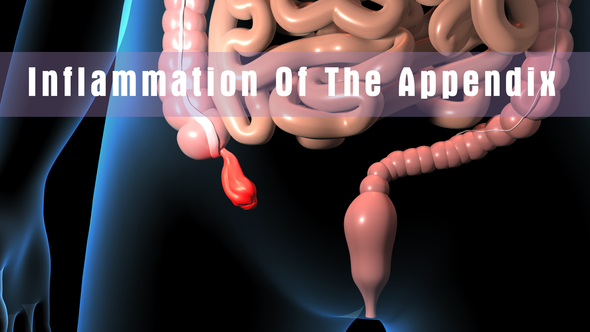 Inflammation Of The Appendix