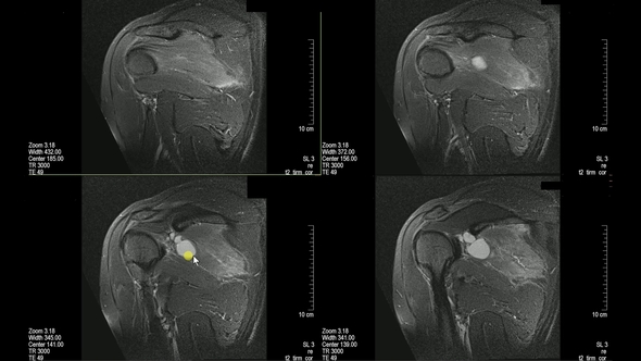 Real MRI Scan of Doctor Examining Male Shoulder and Finding a Lesion an Oedema