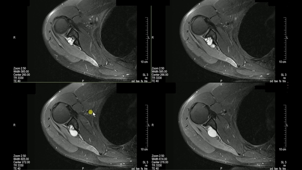 Real MRI Scan of Doctor Examining Male Shoulder and Finding a Lesion an Oedema