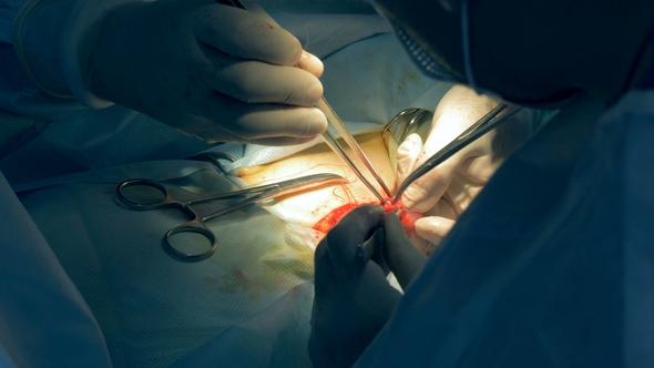 Surgery Process Held on a Human Organ By a Team of Surgeons