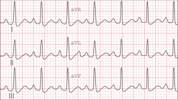 Electrocardiogram Heartbeat