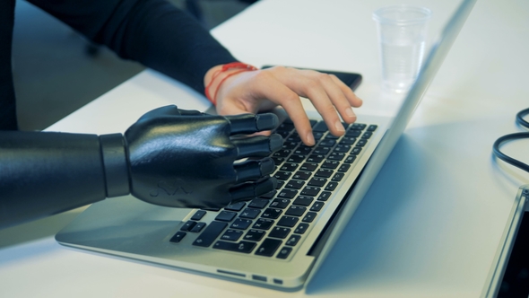 Man Prosthetic and Normal Hands Are Typing on the Keyboard