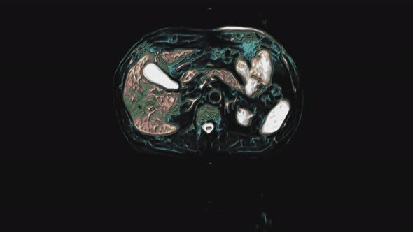 Bulk Multicolored CT Scan of the Abdomen
