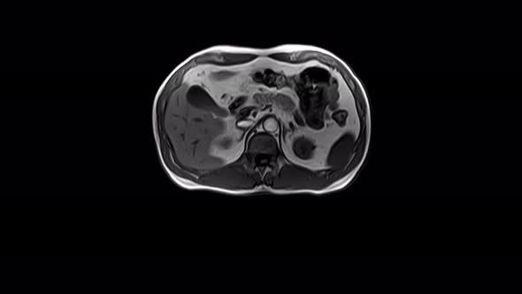CT Scan of the Abdomen