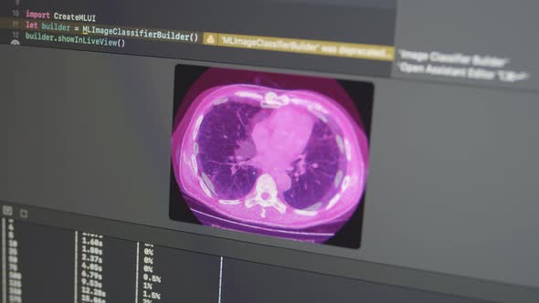 Pulmonary Fibrosis Progression Analysis Training Machine Learning Model