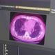 Pulmonary Fibrosis Progression Analysis Training Machine Learning Model - VideoHive Item for Sale