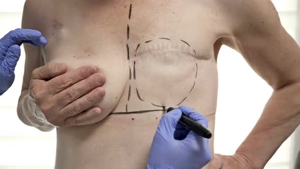 Preparing for Breast Reconstruction for a Woman Undergoing Mastectomy