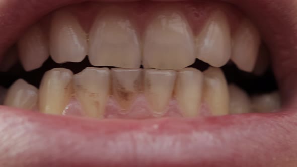 Rotten Human Teeth Closeup