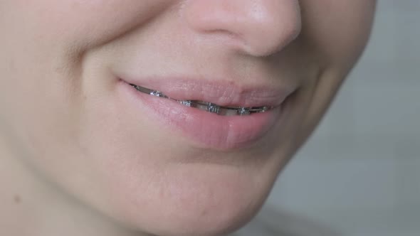 Close Up Beautiful Smile of Woman in Braces