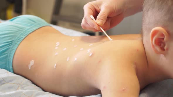 Little Boy with Chickenpox, Mother Applying Antiseptic Cream To Rash