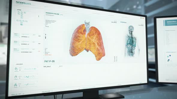 Computer Screen With Working Medical Program Analyzing Lungs Displayed On It alt