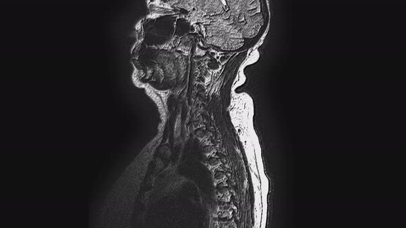 Postoperative Voluminous MRI of Female Organs for the Detection of Metastases