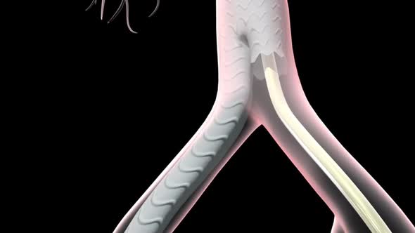 Formation of abdominal aortic aneurysm