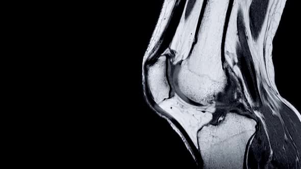 Magnetic Resonance Imaging (MRI) of Right Knee