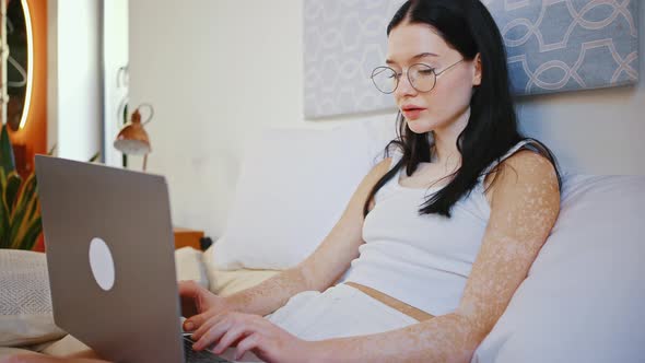 Young Woman Writer with Uneven Pigmentation Wearing Eyeglasses Typing on Laptop Sitting in Bed at