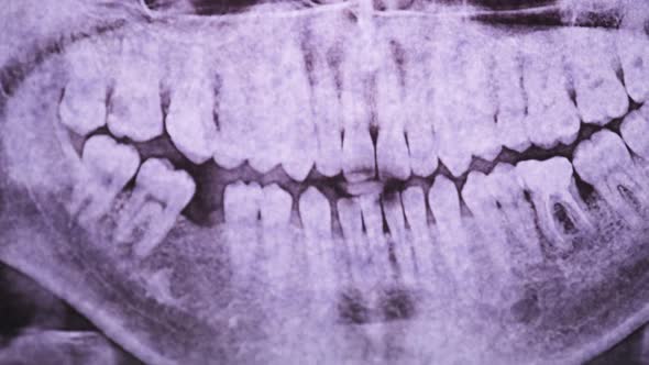 Dental XRay of the Jaw with Teeth Against the Light