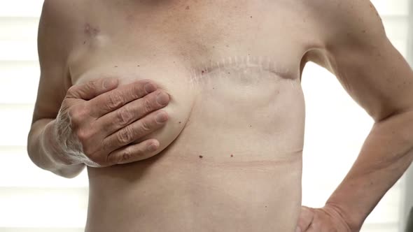 Preparing for Breast Reconstruction for a Woman Undergoing Mastectomy