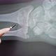 Xray of a Broken Arm - VideoHive Item for Sale