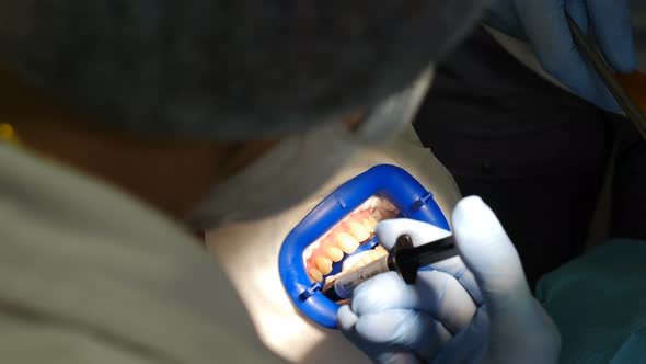 Preparation for Professional Teeth Whitening or Bleaching Procedure in Modern Dental Clinic