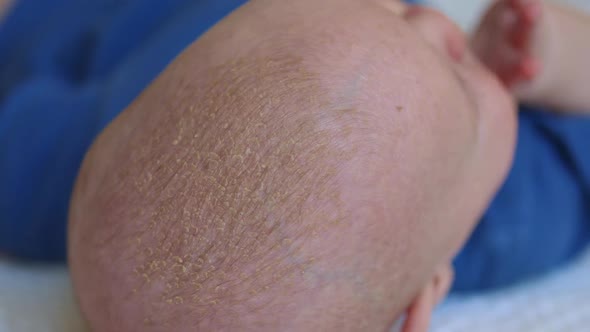 Infant Baby Cradle Cap or Seborrhea Dermatitis