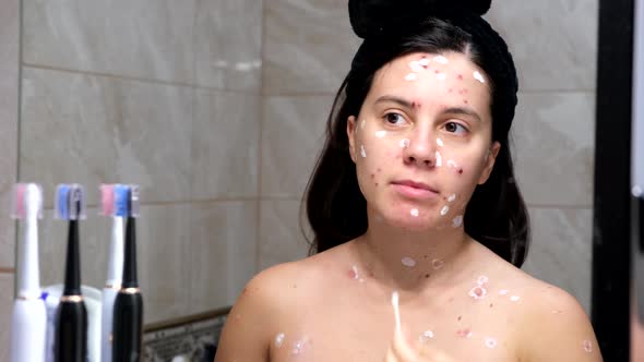 Woman Face Covered with Red Acne Chickenpox Disease