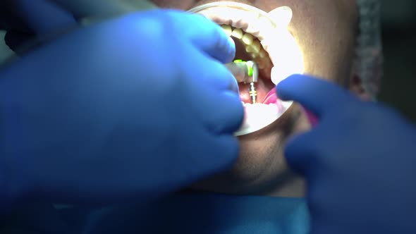 Closeup Mouth of Patient in Dental Chair with Doctor Drilling and Assistant Removing Saliva in Slow