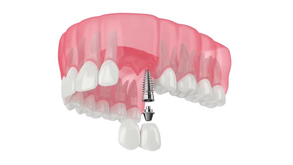 Upper jaw with implant supported dental cantilever bridge isolated over white background