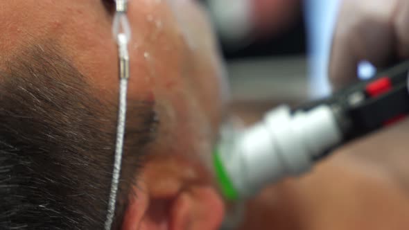 Close up man face depilation laser hair removal procedure treatment