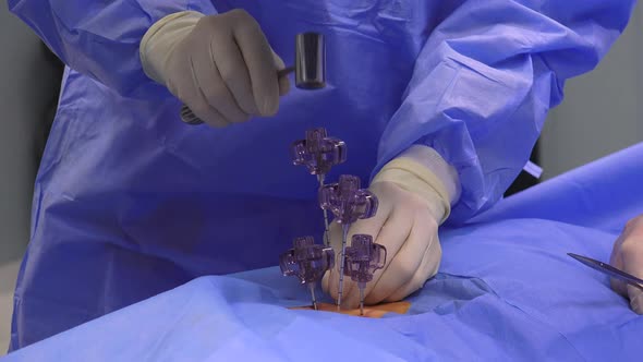 Spine Vertebroplasty Procedure 3