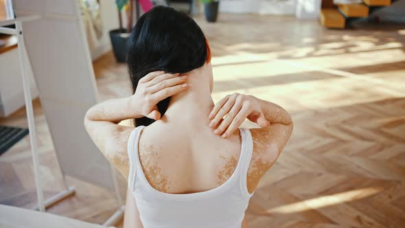 Unrecognizable Woman with Vitiligo Pigmentation Self Massaging Her Back and Shoulders Muscles at