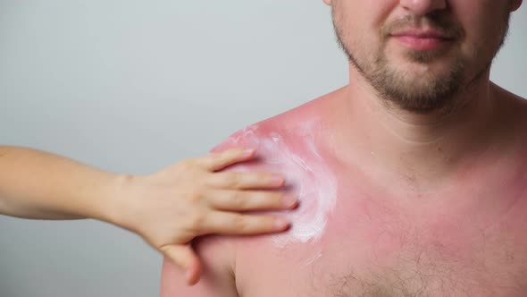 The Process of Applying a Therapeutic Cream to a Sunburn on the Skin of a Man