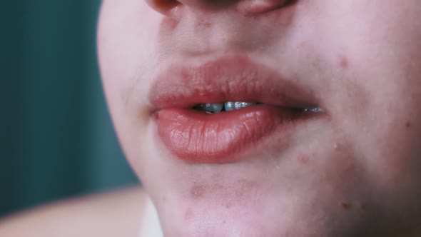 Closeup of Face Lips and Mouth of a Talking Teenager with Acne on Skin