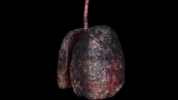 Human Lungs of Smoker