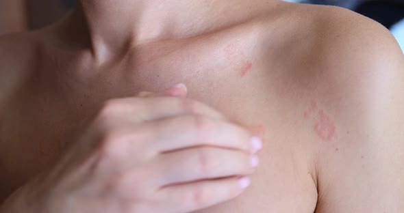 A Woman Scratches a Red Rash on the Skin of Her Chest