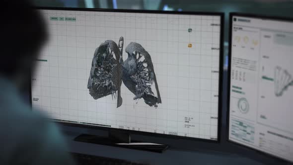 Doctor examines and analyses a lung image on computer. Covid 19 pneumonia.