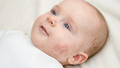 Portrait of cute little baby with red skin suffering from acne or dermatitis. Concept of newborn - PhotoDune Item for Sale