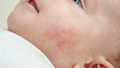 Closeup of baby face with red skin suffering from acne and dermatitis. Concept of newborn baby - PhotoDune Item for Sale