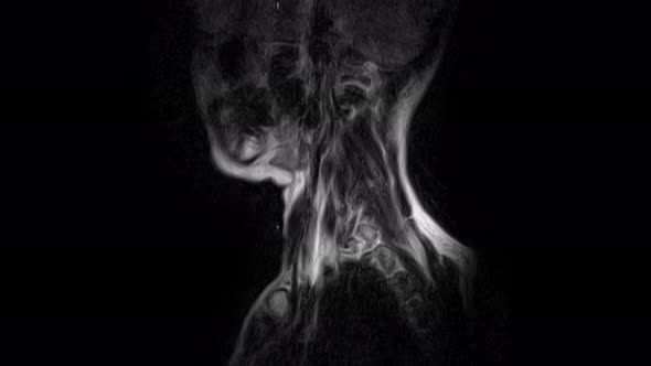 MRI of the Cervical Spine, Detection of Protrusions and Hernias