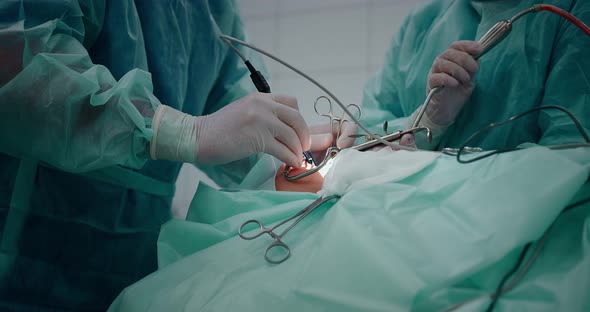 The surgeon performs a surgical operation to remove the tonsils. Pediatric surgery.