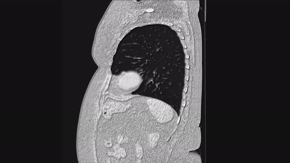 Voluminous MRI of the Lungs and Bronchi, Diagnosis of Viral or Covid-19 Respiratory Disease