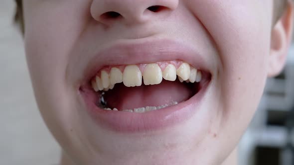 Closeup of the Face of a Smiling Child Showing Teeth