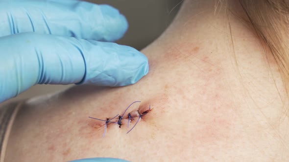 Doctor Hands Checking Stitches After Mold Removal Surgery on Woman Shoulder