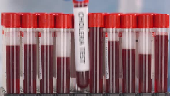 Putting Laboratory Tube with Cholera Test in the Tube Rack