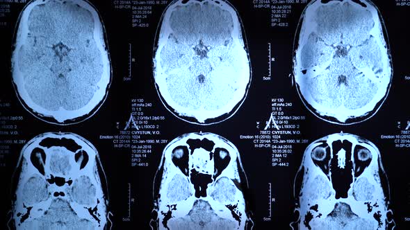 Skull X-Ray