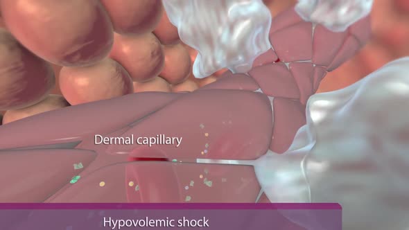Hypovolemic shock occurs due to low fluid volume in the intravascular system.
