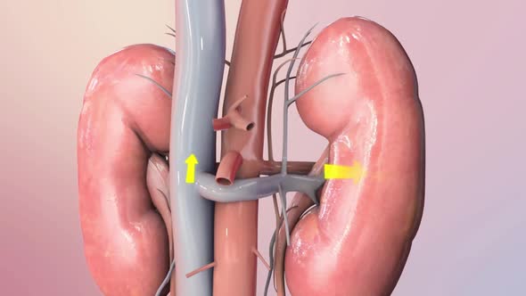 Damage to the kidneys as a result of high potassium levels in the blood.