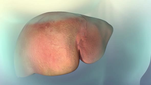 The Progression of Liver Disease. Liver failure damage